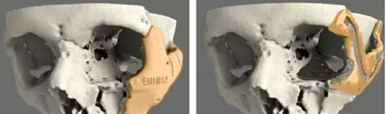 3D打印技术为医疗行业带来的革新