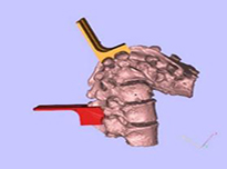 术前指导&手术器械定制-脊柱矫形术截骨导板